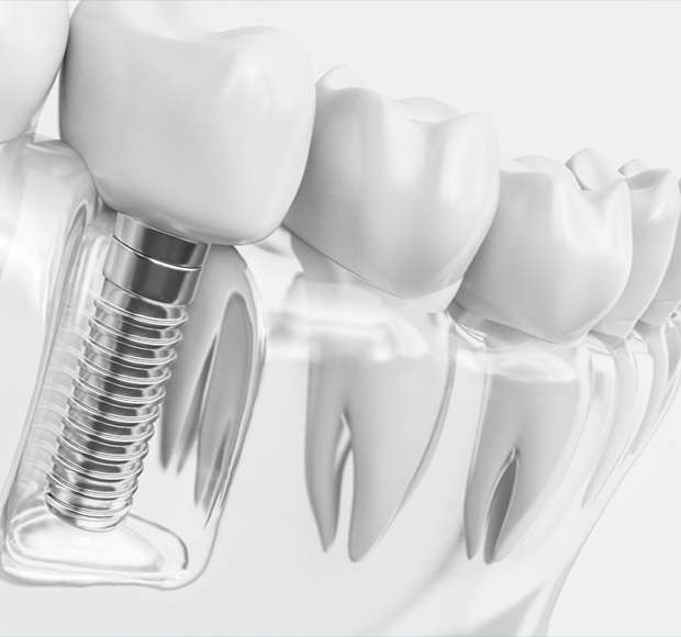 Rehabilitación Oral en Chantada