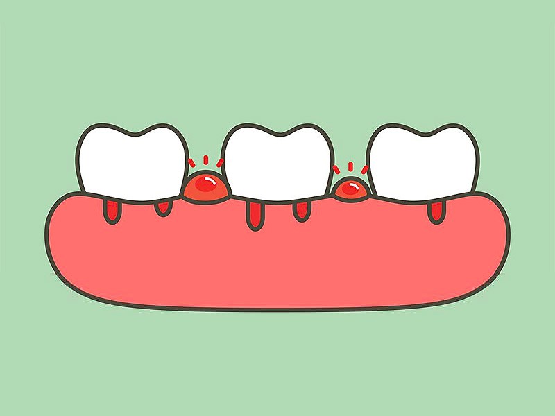 Periodoncia - Clínica Dental Chantada